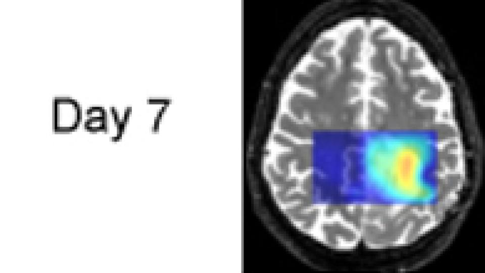 Tumor cells often produce an excess of lactic acid. MRS brain scans show that lactic acid levels are decreasing as treatment proceeds. This patient is an example of a "good responder."