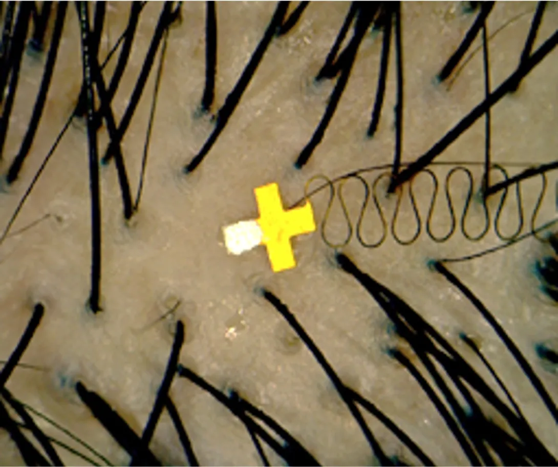 A micro-scale brain sensor placed between hair follicles.