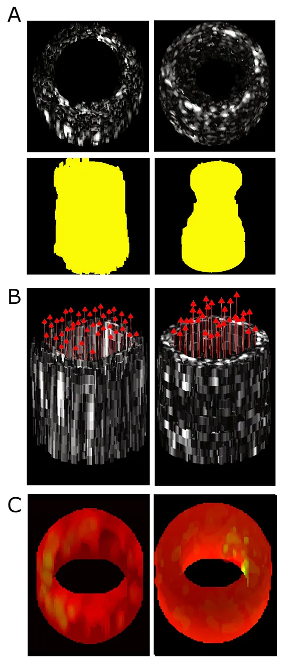 This figure shows 3D functional imaging with a prototype forward-viewing device in laboratory models of narrowed vessels: (A) Conventional ultrasound imaging of lesion morphology in straight and stenotic, or narrowed, vessels, with extracted lumen shape shown in yellow, (B) 3D vector velocity imaging in straight and stenotic vessels, and (C) Strain rate imaging of a control vessel model and a model with a soft inclusion on the right inner surface. (Image Courtesy: Brooks Lindsey)