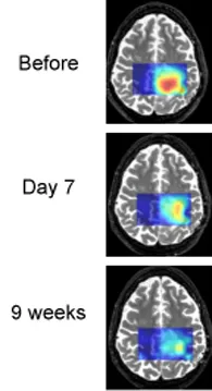 Tumor cells often produce an excess of lactic acid. MRS brain scans show that lactic acid levels are decreasing as treatment proceeds. This patient is an example of a "good responder."
